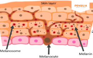 điều trị nám da do melanin