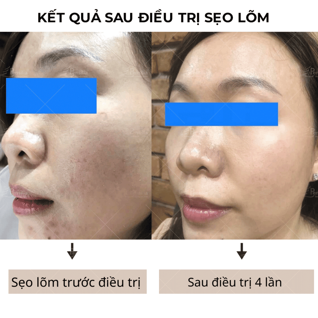 Hiệu quả trị sẹo lõm