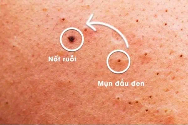 Mụn đầu đen và nốt ruồi 