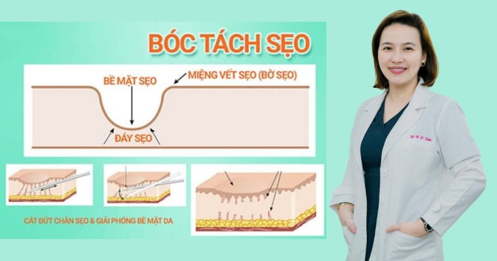 tách đáy sẹo lõm sẹo rỗ