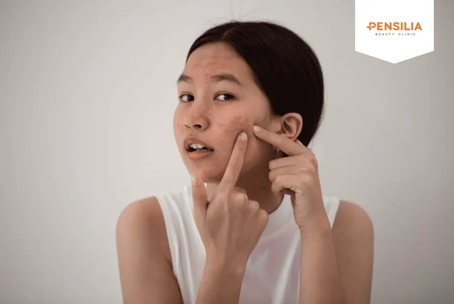 trị mụn tại nhà