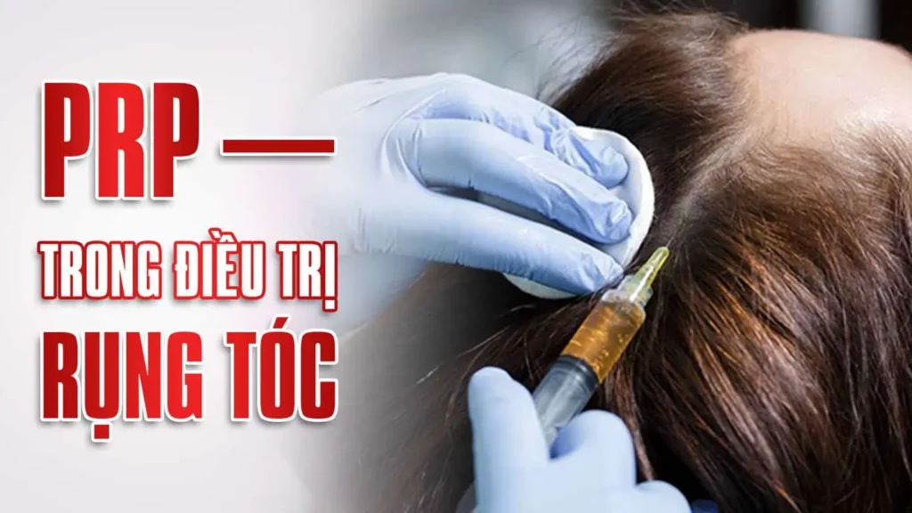 Trị rụng tóc BẰNG PRP – Máu tự thân CÓ HIỆU QUẢ KHÔNG?