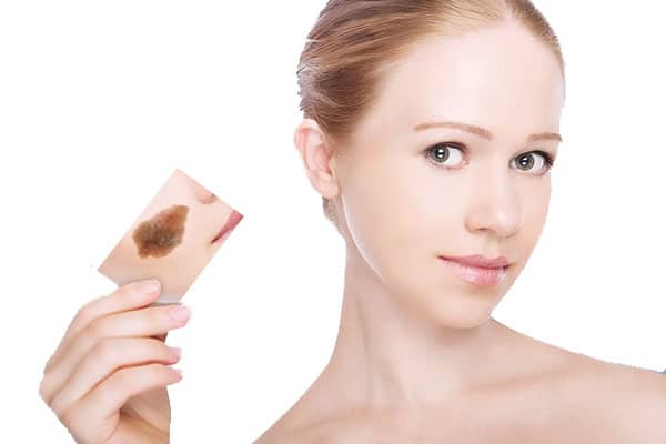 Những điều cần biết về bớt sắc tố Ota nevus