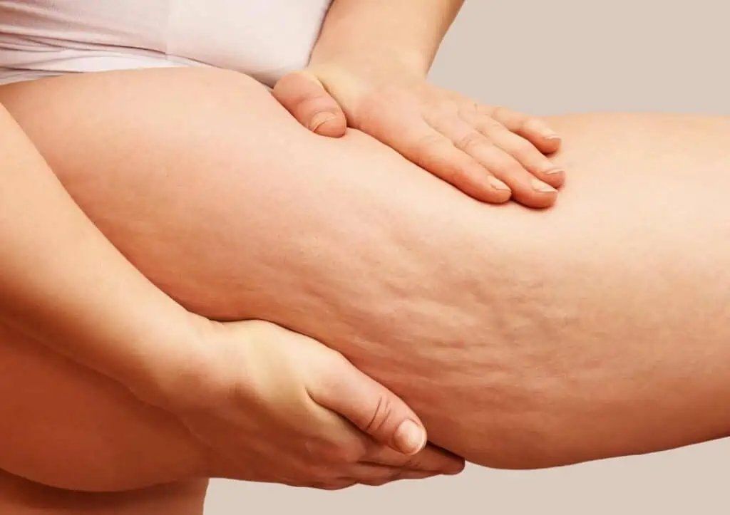 Cách loại bỏ cellulite (sần da vỏ cam) giúp bạn tự tin hơn