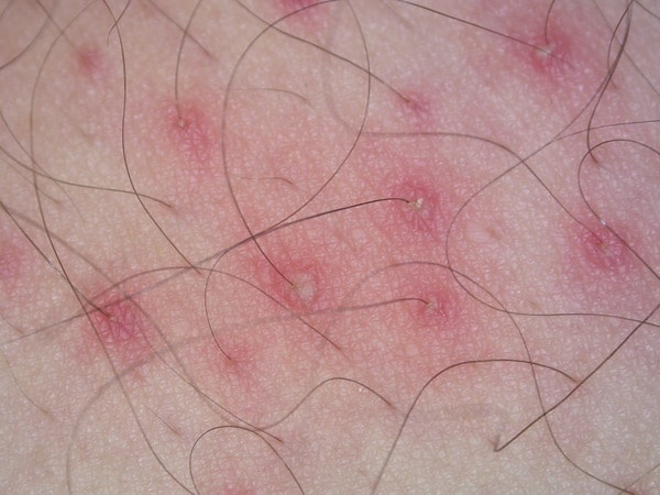Viêm nang lông xuất hiện ở khắp cơ thể
