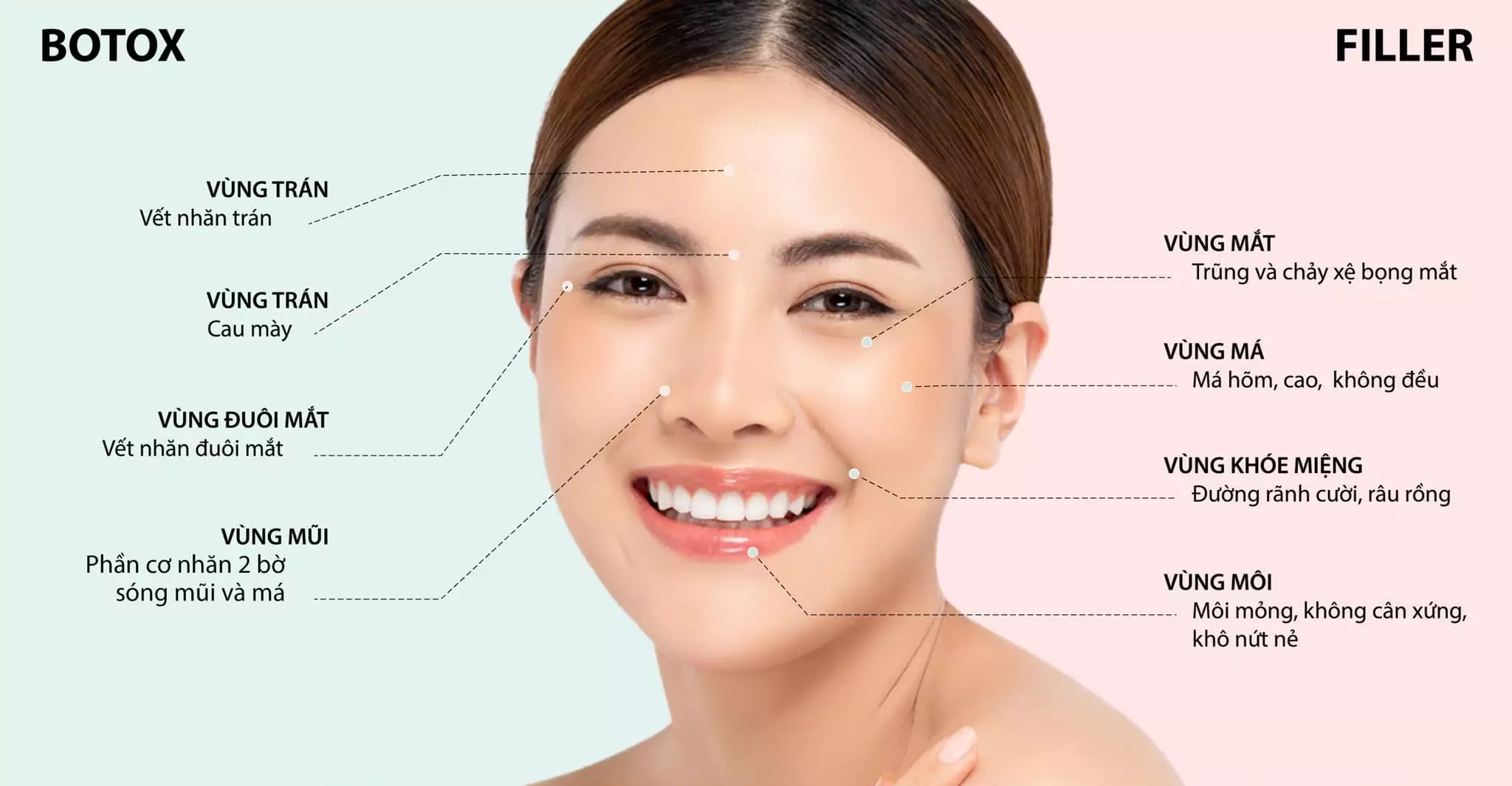 phương pháp trẻ hóa da Botox và filler