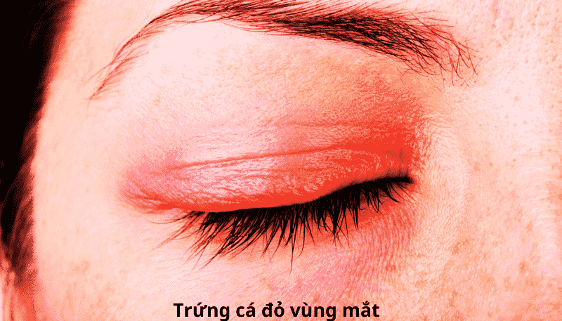 Trứng cá đỏ vùng mắt