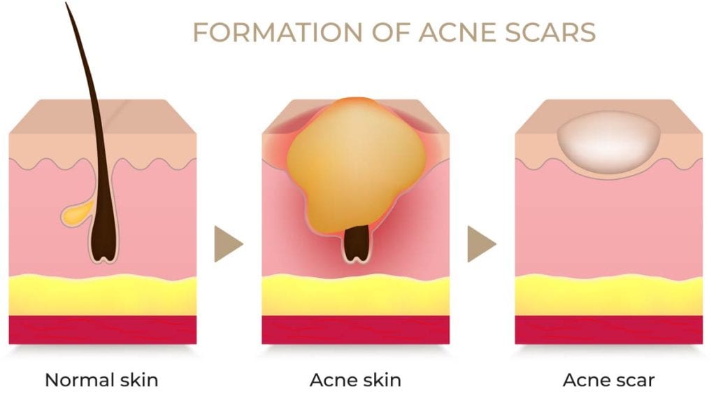 Quá trình hình thành sẹo mụn
