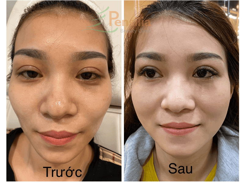 Thực hiện tiêm filler trẻ hóa da tại Pensilia