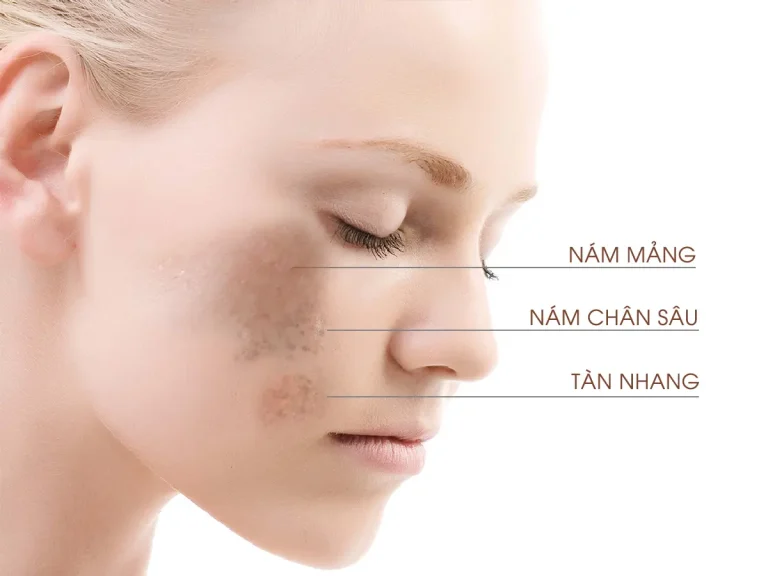 Nám thường được chia làm hai loại: nám nông (nám mảng), nám sâu (nám chân sâu, hori, nám hỗn hợp,..)