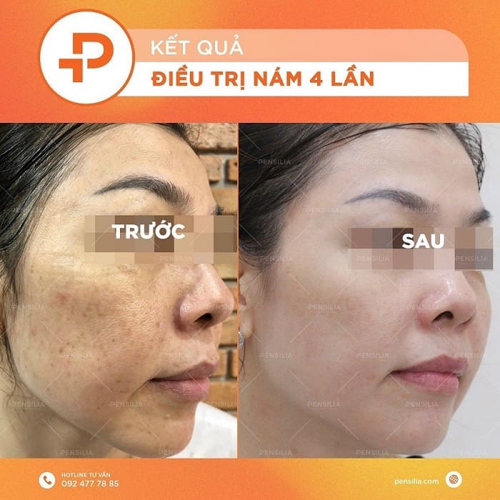 Điều trị nám da tại Pensilia