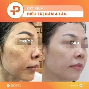 Hiệu quả điều trị nám sau 4 lần laser yag