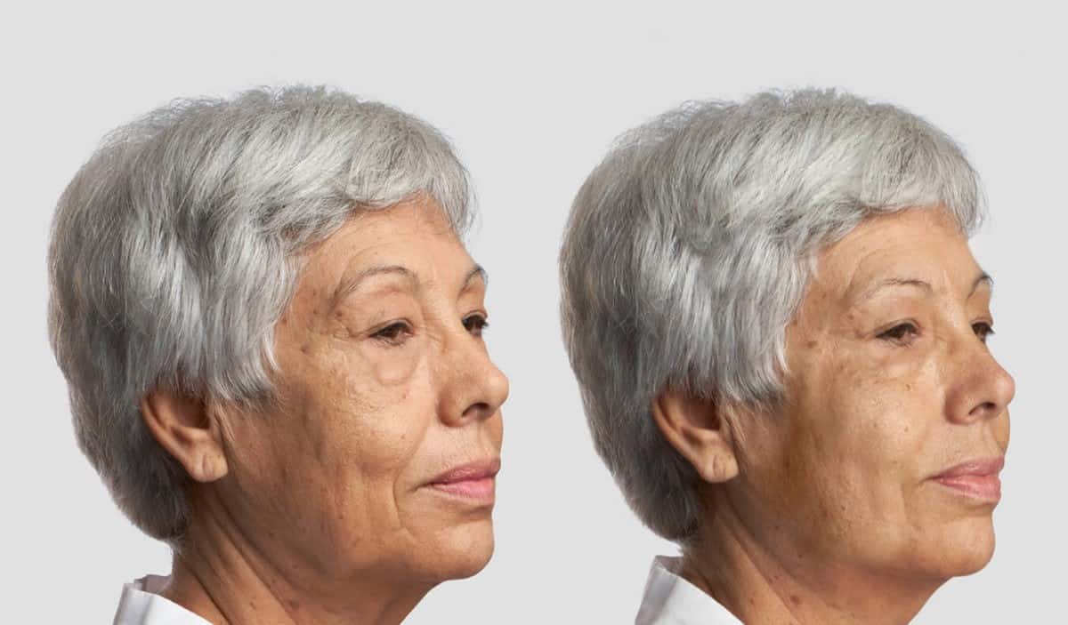Căng chỉ collagen - hiệu quả
