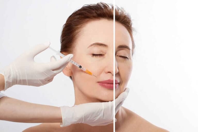 Căng da mặt bằng chỉ Collagen – Xu hướng làm đẹp không phẫu thuật, xâm lấn