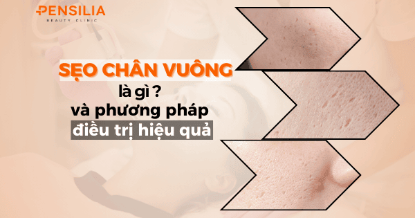 Sẹo chân vuông là gì