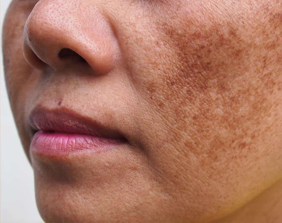 Triệu chứng rõ nhất của da chính làn da sạm màu thành đốm hoặc mảng