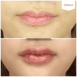 Filler môi tại Pensilia