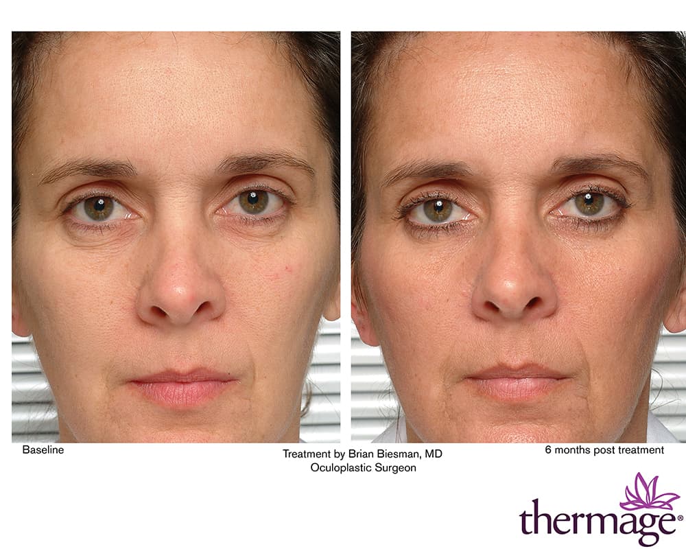 Thermage FLX - Eyelid Treatment by Brian Biesman, MD. Pre and 6 months post. Combination tip study