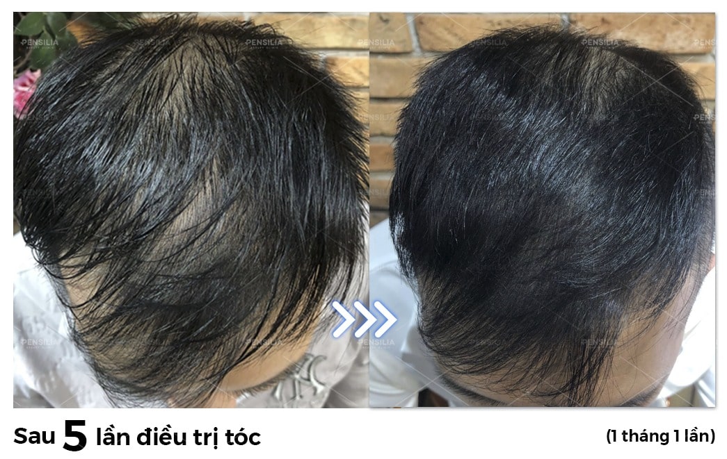 liệu trình pen hair trị rụng tóc hói đầu.