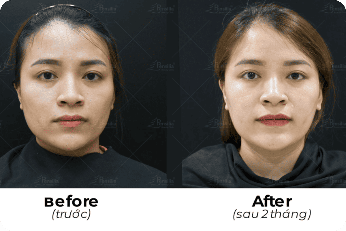 botox thon gọn hàm