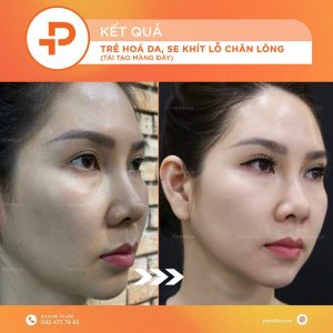 Kết quả điều trị Pensilia