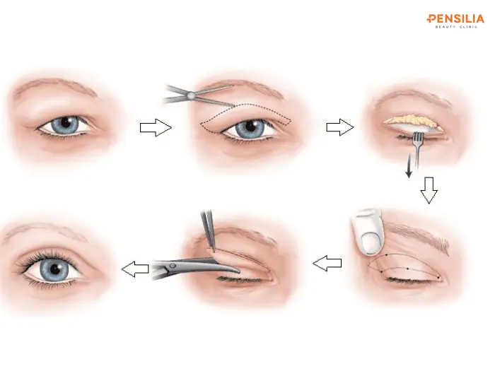 Thao tác cắt mí mắt khá đơn giản nhưng cần được đo đạc kỹ lưỡng nếu muốn đường mí tự nhiên, không quá nông hoặc quá sâu.
