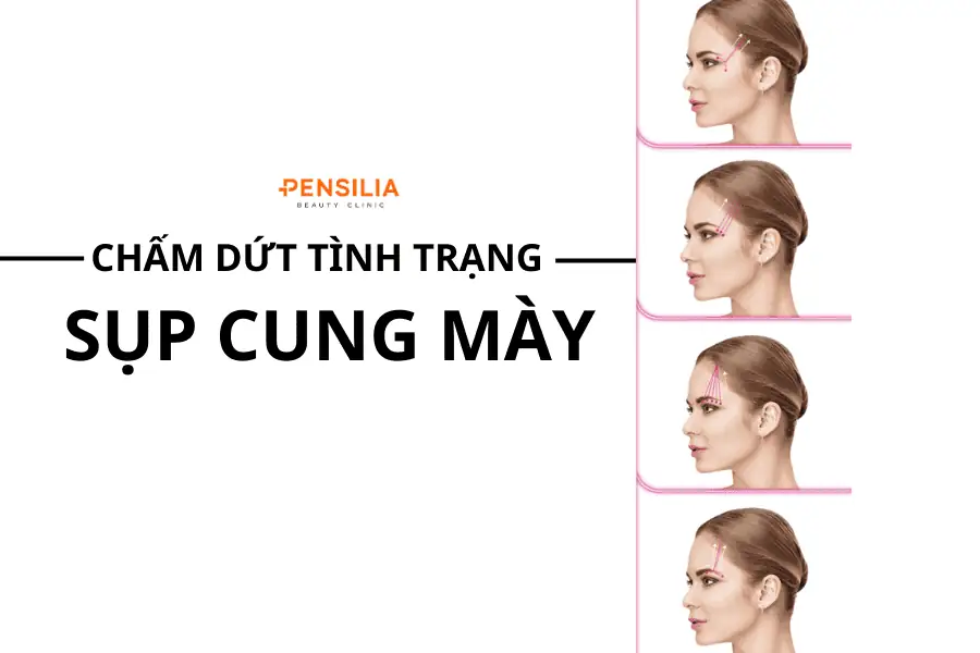 chấm dứt sụp cung mày tại Pensilia