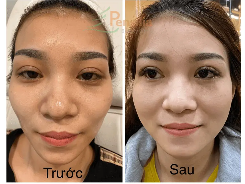 tiêm filler tăng sinh collagen Pensilia