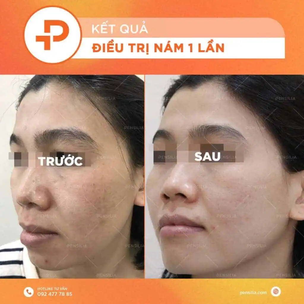 Kết quả điều trị nám da