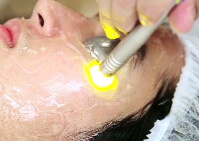 Laser đồng ánh sáng kép điều trị đỏ da mặt