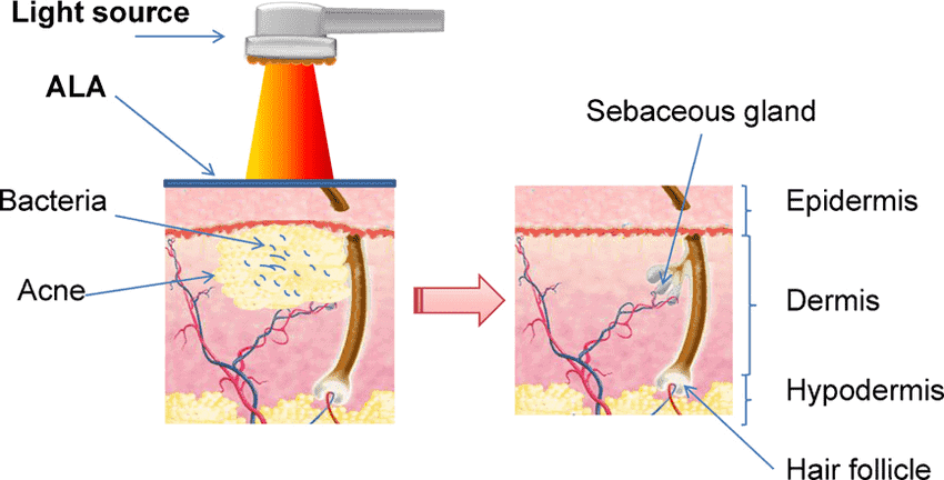 Công nghệ ALA trị mụn
