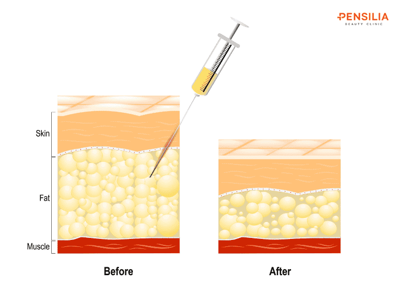 Tiêm thuốc vào vùng mỡ thừa để ly giải mỡ