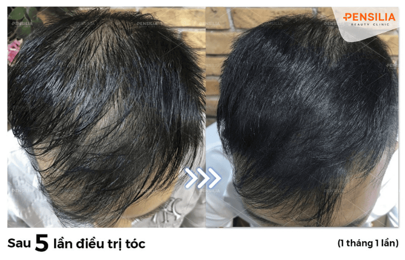 Kết quả của Pen Hair sau 05 lần điều trị tóc rụng nhiều, thưa