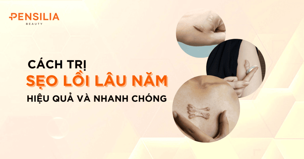 Cách trị sẹo lồi lâu năm hiệu quả và nhanh chóng