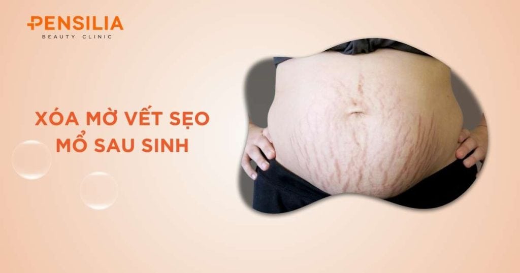 Xóa Mờ Vết Sẹo Mổ Sau Sinh