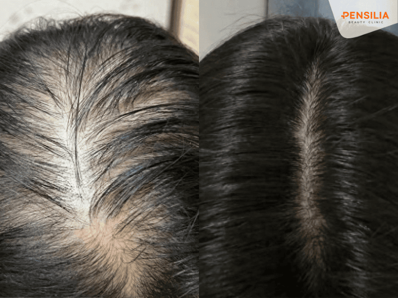 Hiệu quả điều trị rụng tóc với liệu trình Pen Hair