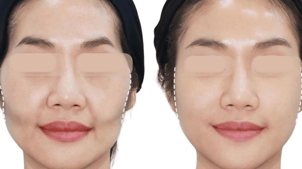 Filler làm đầy má hóp giúp khuôn mặt tươi trẻ, rạng rỡ hơn