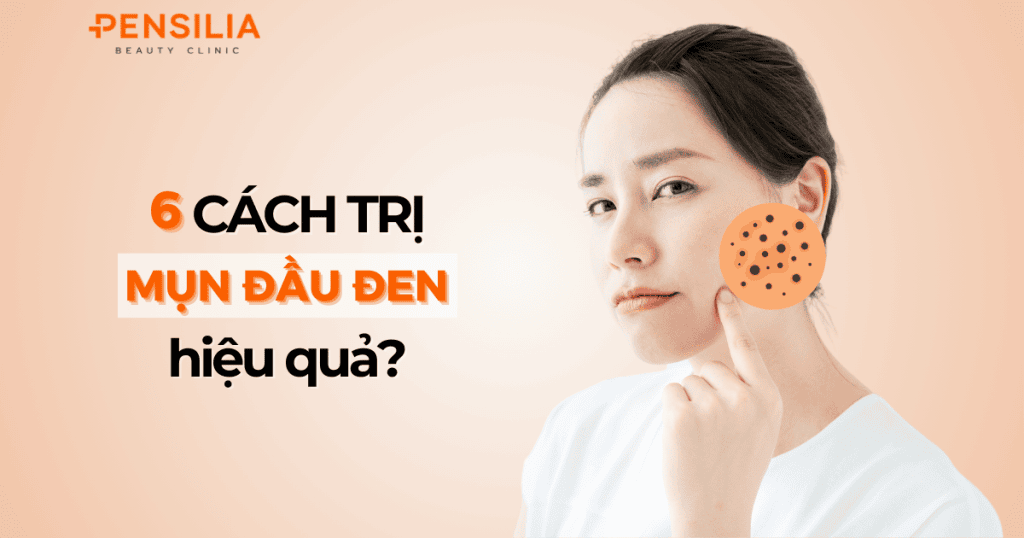 6 cách trị mụn đầu đen hiệu quả tại nhà