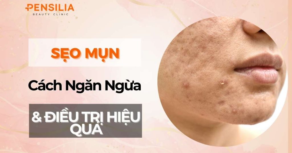 Cách điều trị và ngăn ngừa sẹo mụn hiệu quả