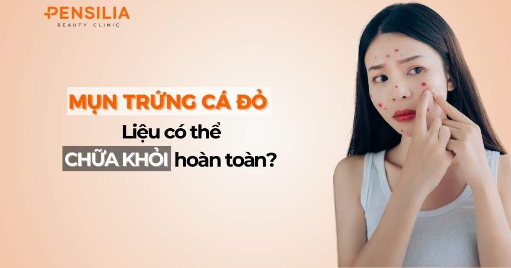 Mụn trứng cá lươn: Những điều cần biết để điều trị thành công