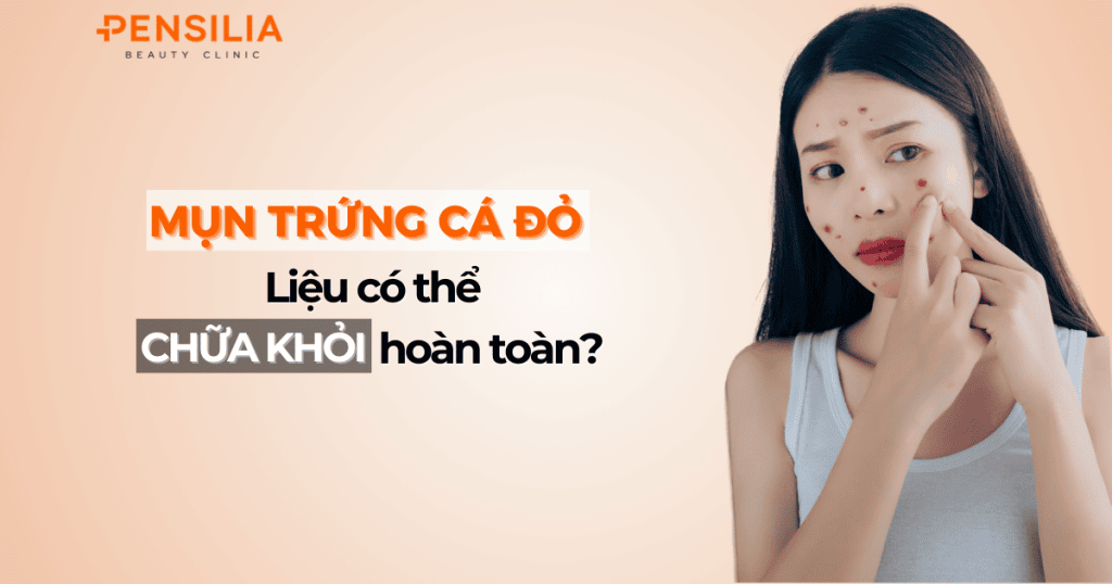 Mụn trứng cá đỏ - Liệu có thể chữa khỏi hoàn toàn