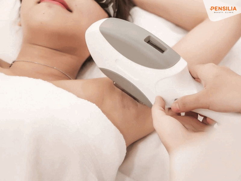 Triệt lông bằng công nghệ IPL