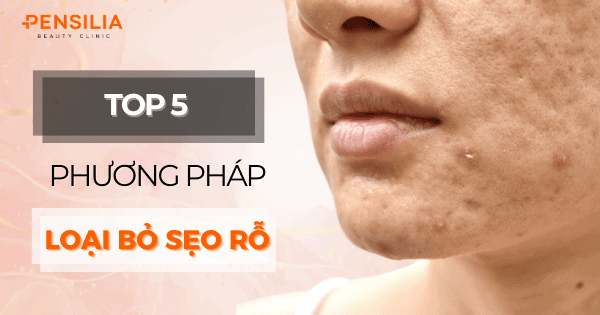 Top 5 phương pháp trị sẹo rỗ hiệu quả hiện nay