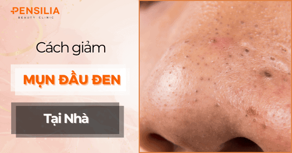 Cách đơn giản giảm mụn đầu đen ở mũi tại nhà