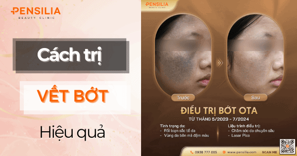 Cách Trị Vết Bớt Hiệu Quả: Phương Pháp Tốt Nhất Bạn Nên Biết