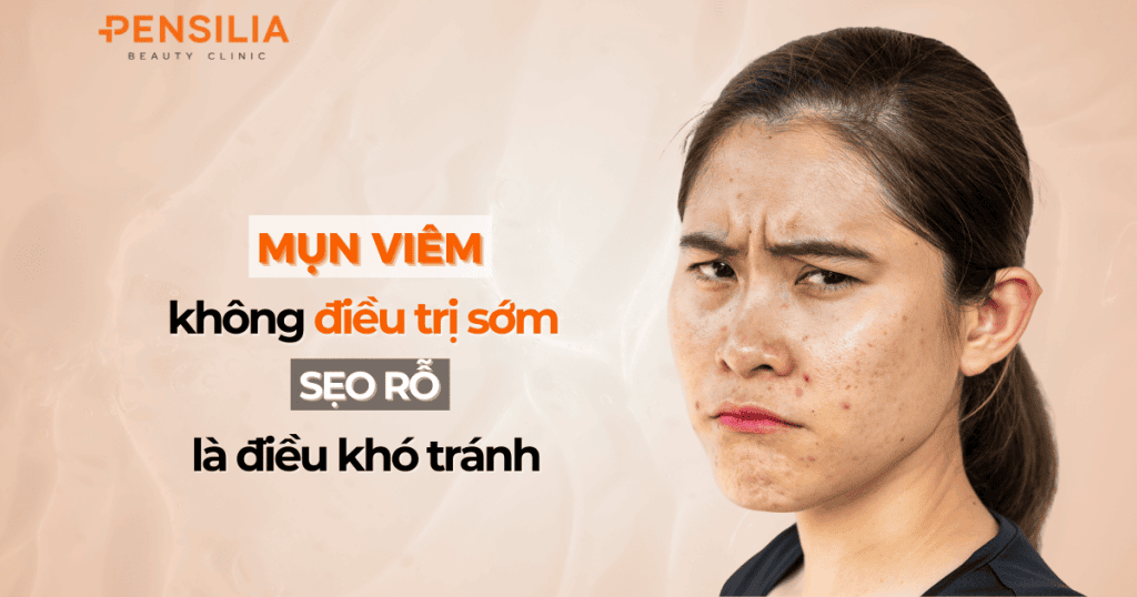 Mụn viêm không điều trị sớm, sẹo rỗ là điều khó tránh