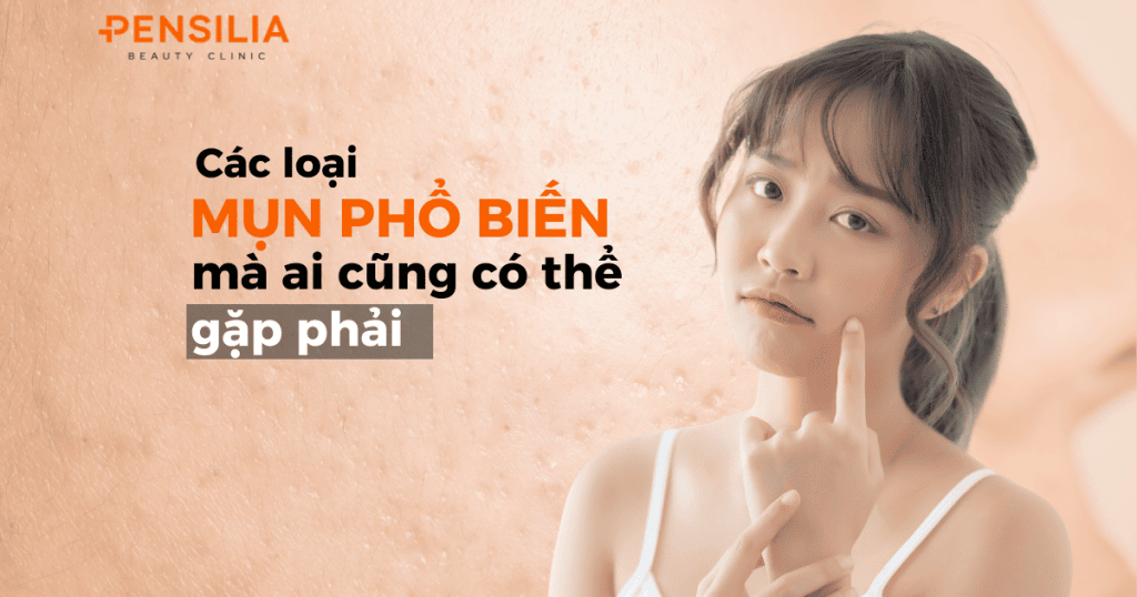 Các loại mụn phổ biến