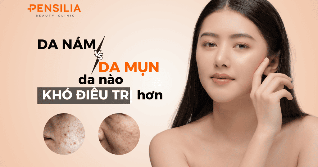 Da nám hay da mụn khó điều trị hơn