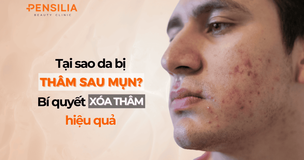 Tại sao da bị thâm sau mụn Bí quyết xóa mờ vết thâm hiệu quả