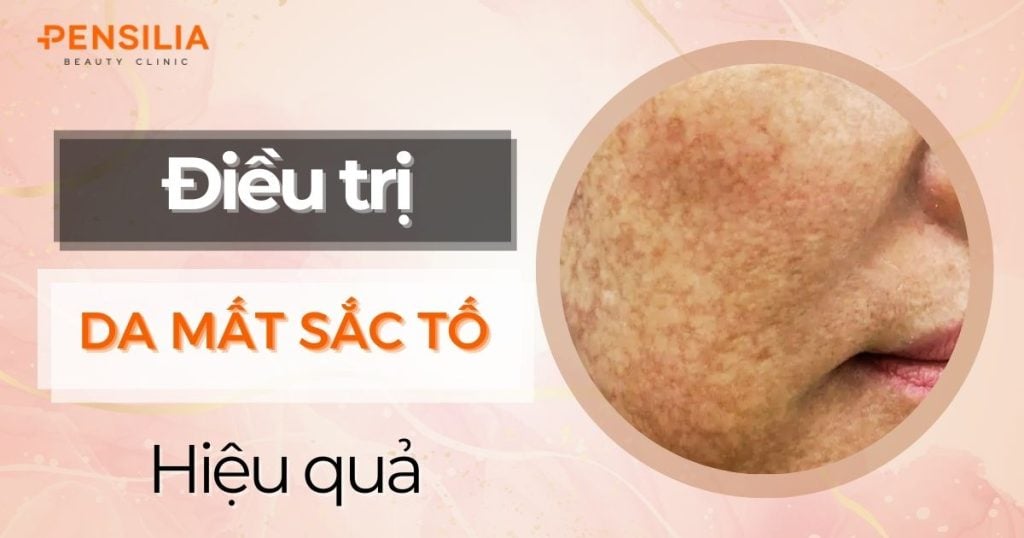 Làm thế nào để điều trị mất sắc tố da an toàn và hiệu quả